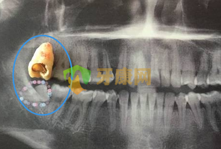 拔牙后的六大注意事项