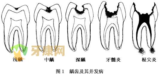 智齿患牙髓炎拔牙治疗好不好