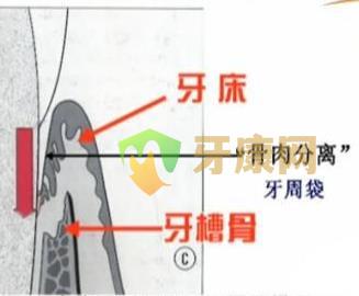 牙周炎是否会传染？牙周炎如何治疗？