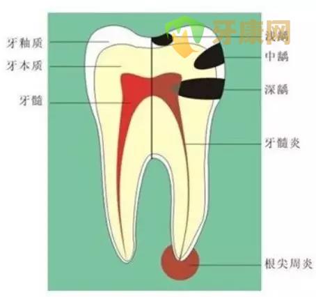 根尖周炎