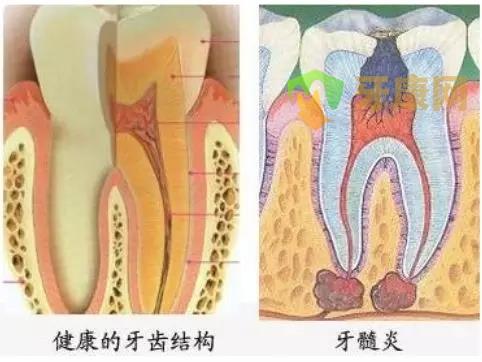 根管治疗