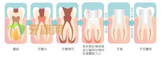 窝洞制备