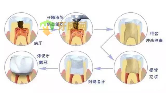 根管治疗