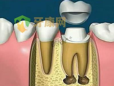 根管治疗后 别忘给牙齿戴上“**帽”！