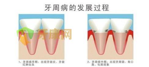 牙康网牙周炎发展过程