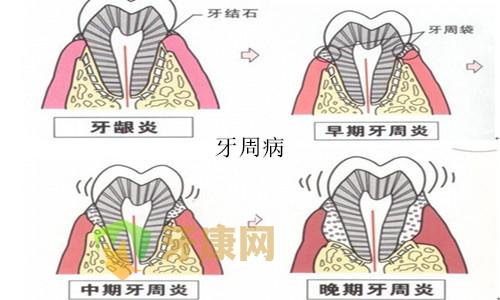 牙周炎不同时期的症状