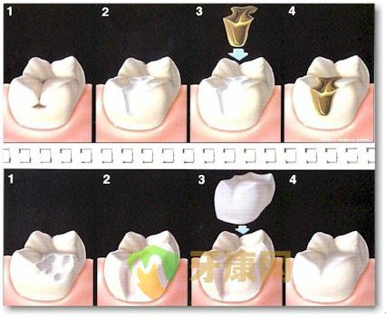 牙康网医生浅析：补牙后材料为什么会掉?