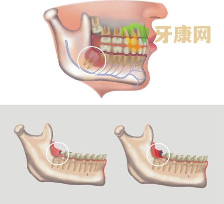 拔完智齿多久才不痛？