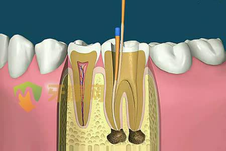 什么是根管治疗？什么情况需要做根管治疗？
