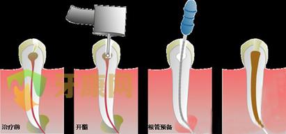 根管治疗和补牙有什么区别？