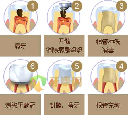 根管治疗后牙齿能用多久