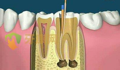  牙齿根管治疗有副作用吗？