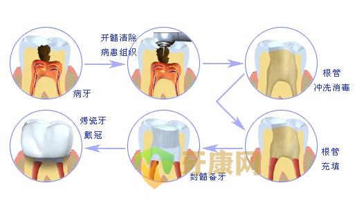 根管治疗和杀神经有什么区别？