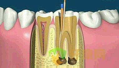 根管治疗常见问题解答