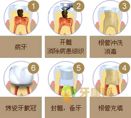 治疗牙齿根尖炎较有效的方法是什么？