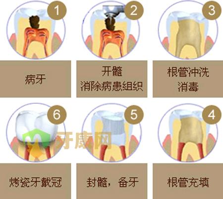 深圳牙康网根管治疗结果怎么样？