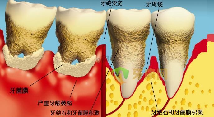 牙周炎必须要做龈下刮治吗？