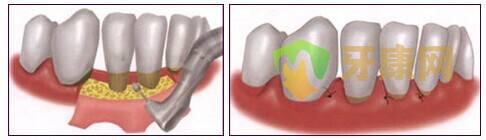 牙周治疗之翻瓣手术是什么？