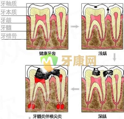 根管治疗的填充材料有哪些？