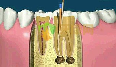 什么样的蛀牙需要做根管治疗？