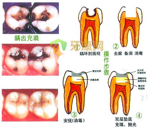 根管治疗**吗？