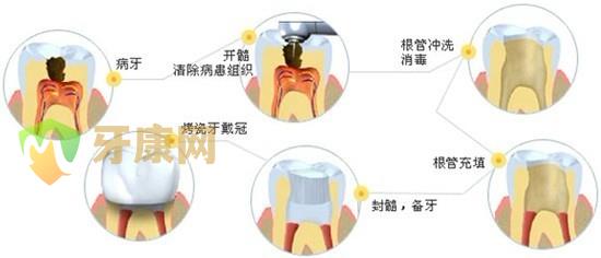 根管治疗分为哪几个步骤