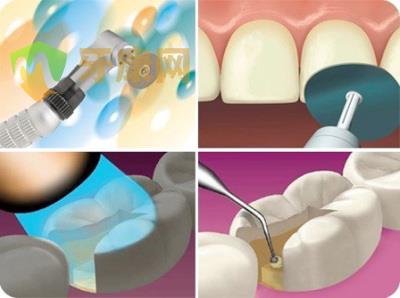复合树脂补牙是怎样的？