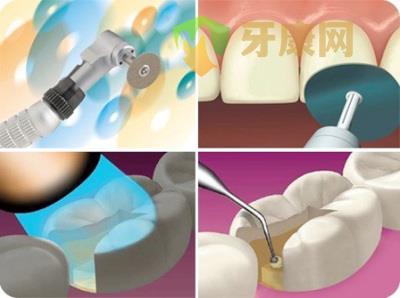 复合树脂补牙过程是怎样的