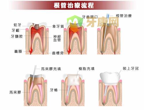 杀神经补牙的步骤