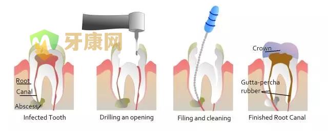 根管治疗