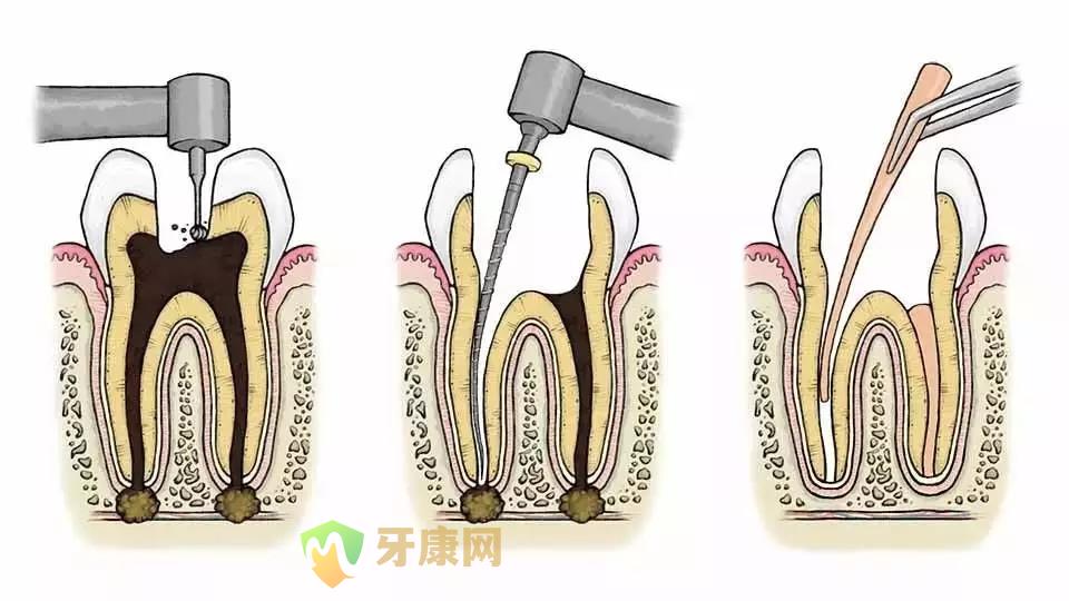 急性根尖周炎