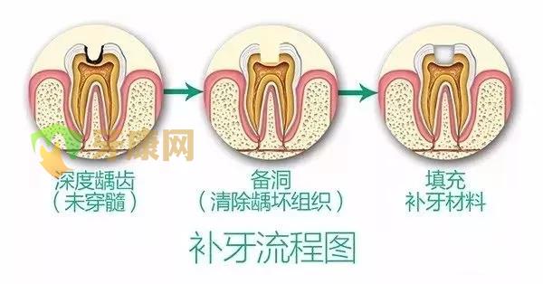 补牙