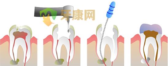 根管治疗