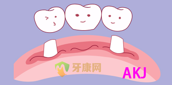 烤瓷牙示意图片