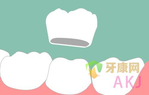 烤瓷牙