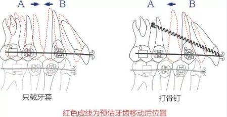 打骨钉和不打骨钉的牙齿移动情况