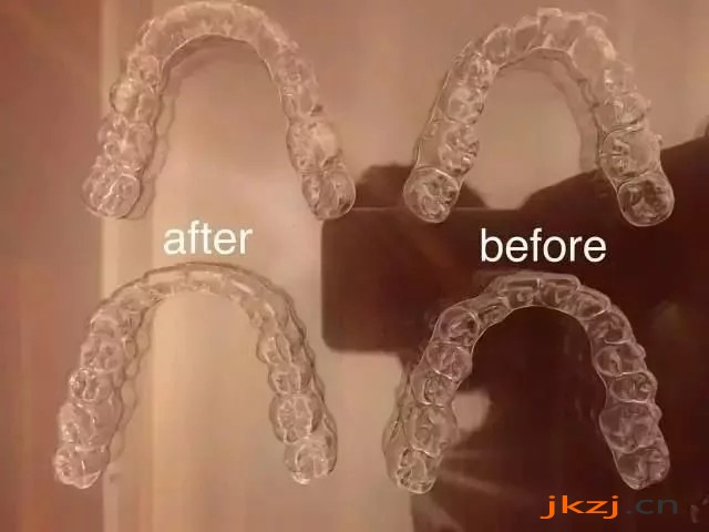 龅牙的矫正方法