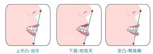 地包天怎么办