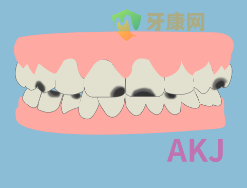 蛀牙黑牙 蛀牙黑牙