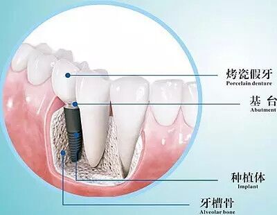牙龈萎缩做种植牙
