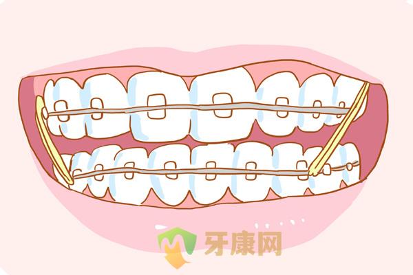 儿童矫正门牙牙齿方式