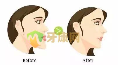 牙齿反颌、牙齿对脸型的影响到底有多大？