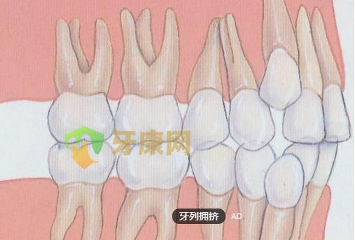 牙齿拥挤——笑容不自信