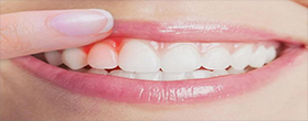 牙康网-烤瓷牙术后护理
